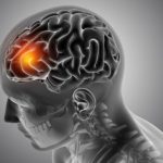 Brain Injury Compensation