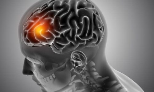 What Brain Injury Compensation Really Covers (and Why It Matters)